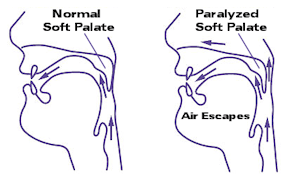 softpalate1